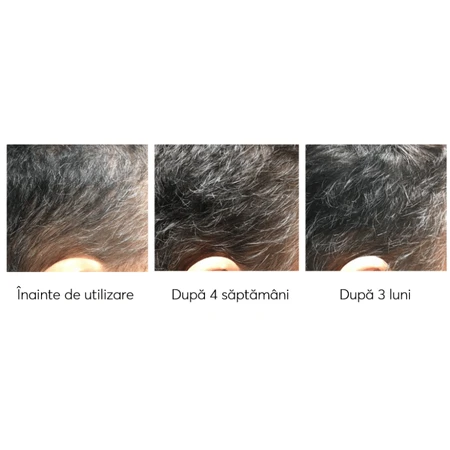 Kit impotriva caderii parului, Ageless Clinic, 3 bucati, Ru:t hair, 80 ml, Biocart