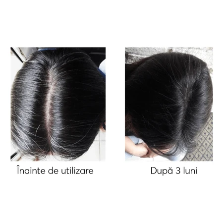 Kit impotriva caderii parului, Ageless Clinic, 3 bucati, Ru:t hair, 80 ml, Biocart
