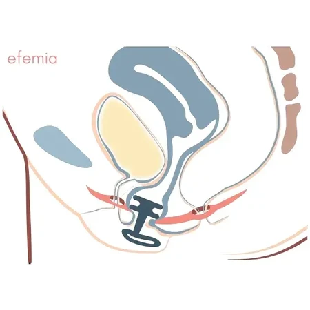 EFEMIA Pessar Female incontinence insert, 3 pcs